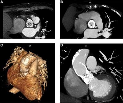 Case report: Infective endocarditis after transcatheter aortic valve implantation surgically treated with sutureless prosthesis and ascending aorta replacement